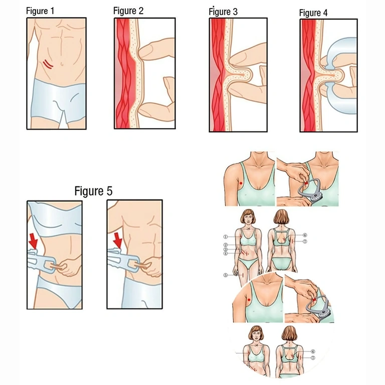 Hogyan használjuk a bőrredő mérőt testzsír méréséhez